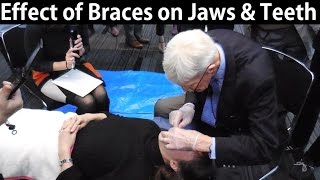 How Do Orthodontic Braces Change Upper amp Lower Jaws Position amp Teeth Misalignment by Prof John Mew [upl. by Judah176]