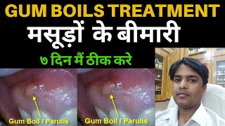 how to cure gum disease  Best treatment for gum disease  gum boils homeopathic treatment [upl. by Cibis]