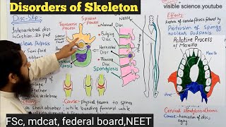 deformities of skeleton class 12  disorders of human skeleton class 12 [upl. by Godart]