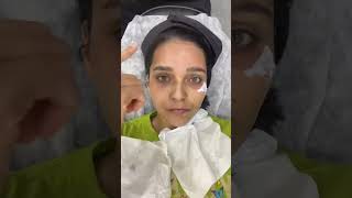 MNRF treatment first session microneedling radiofrequency [upl. by Furr]