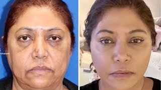 INCREDIBLE Facelift transformation before and after [upl. by Akkin]