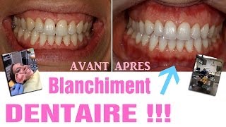 Blanchiment dentaire  AVANTAPRES Revue 25 [upl. by Chessa807]