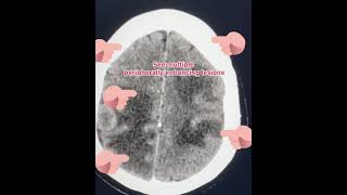 Multiple brain metastasis pre and post contrast ct head [upl. by Enitnatsnoc]