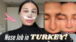 Rhinoplasty inTurkey [upl. by Leacock]