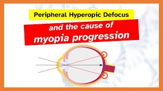 Peripheral hyperopic defocus and the cause of myopia progression explained [upl. by Atteuqahc]