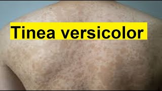 Tinea versicolor dermatologist DrDrayzday [upl. by Catina]