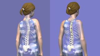 What is Scoliosis surgery [upl. by Freemon]