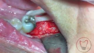 Delayed Implant Placement for Mandibular Molar 19 [upl. by Tymothy]