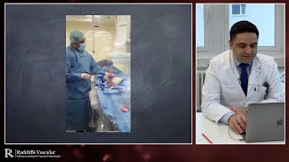 Treating calcified lesions using the Shockwave Lithoplasty® System  Prof K Donas [upl. by Sergei463]