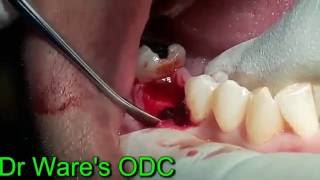 Immediate implant placement in mandibular molar region [upl. by Yellhsa]