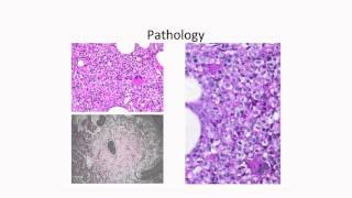 Molecular Profiling of Myelodysplastic Syndromes [upl. by Ailenroc595]