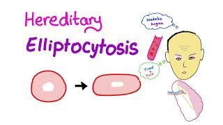 Hereditary Elliptocytosis HE [upl. by Aziul86]