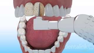 CARILLA DENTAL estética anterior  Video 3D paso a paso [upl. by Johnna394]