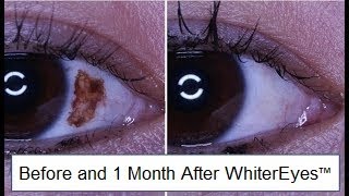 Eye Freckle Pigment Treatment with WhiterEyes® Eye Whitening [upl. by Silirama]