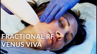 Venus Viva Fractional Radiofrequency Facial Rejuvenation  LIVE [upl. by Fraze272]