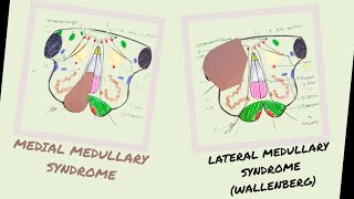 Medial amp Lateral Medullary Syndromes  Wallenberg Syndrome  Vascular lesions of Medulla [upl. by Koah]