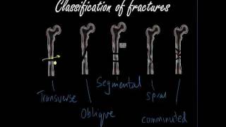 Classifying and presenting Fractures  Orthopaedics for Medical Students  Finals [upl. by Dlonyer]