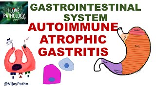 AUTOIMMUNE ATROPHIC GASTRITIS Pathogenesis clinical features morphology amp prognosis [upl. by Kenney]