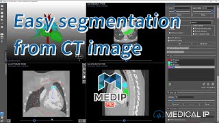 MEDIP PRO  SEGMENTATION [upl. by Akinhoj]