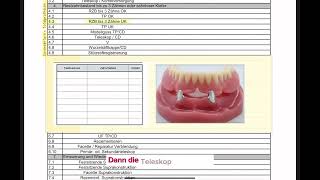 CoverdentureProthesen oder Deckprothesen  HKP abrechnen 34 [upl. by Leonor]