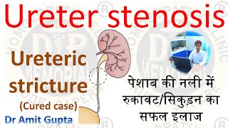 PUJ OBSTRUCTION Ureter stricture cured case without surgery Homoeopathy [upl. by Accever707]