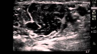 ultrasound guided musculocutaneous nerve block [upl. by Walston275]