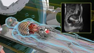 ViewRay MRIdian MR linac explained [upl. by Marci822]