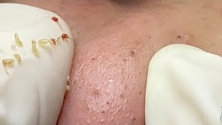 Maryim Prise Acne Treatment 26 acne blackheads whiteheads treatments pimple акне прыщи [upl. by Cimbura593]