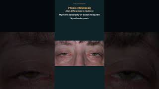 Ptosis Causes of bilateral ptosis osce practicalmedicine diagnosis [upl. by Notrab]