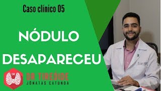 Nódulo que desapareceu  Caso clínico 05  Dr Jônatas Catunda [upl. by Chapland]