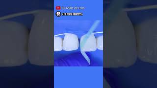 CLOSING The Diastema While Replacing The Old Stained Restoration dental toothrestoration [upl. by Lewak275]