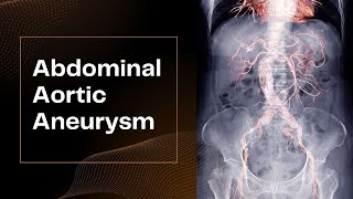 Abdominal Aortic Aneurysm [upl. by Lynnea817]