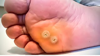 How To Remove a Foot Corn or Callus Foot Doctor Home Treatment [upl. by Ethelbert]