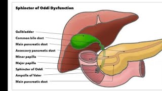 Mystery diagnosis sphincter of oddi dysfunction [upl. by Mahmoud]