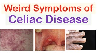 Weird Symptoms of Celiac Disease  Atypical Clinical Features [upl. by Nutter25]