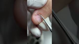 Nail biting repair nailreplacementprocess polygelnail viralnails nails shortsvideo [upl. by Enitsej]