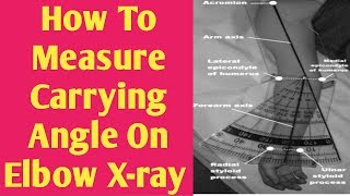 How to measure carrying angle on elbow Xray [upl. by Kcin82]