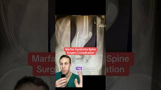 Rare spine surgery complication causes knee pain in Marfan Syndrome patient [upl. by Mcwherter133]