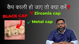 दाँतों की कैप काली हो जाए तो क्या करें What to do if Dental cap turns black AskDentist [upl. by Sheri49]