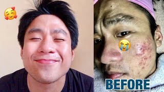 EFFECTIVE PRODUCTS FOR SEVERE ACNE  SKINCARE [upl. by Eynaffit]