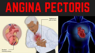 ANGINA PECTORIS  Chest Pain  Types  Causes Risk factors  NITROGLYCERIN  Management [upl. by Naesad]