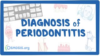 Diagnosis of Periodontitis [upl. by Woo]