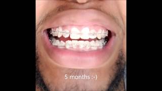 Braces 6 Month Timelapse [upl. by Elimac641]