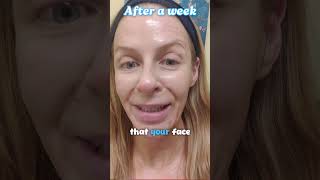 Wrinkles Be Gone with AtHome Chemical Peels nobotox antiagingskincare chemicalpeels [upl. by Kellie]