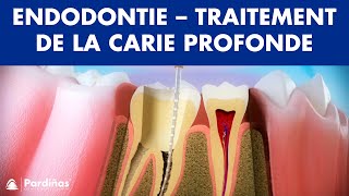 Endodontie  Traitement de la carie profonde © [upl. by Gretel]