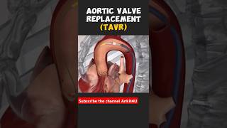 Angioplasty Procedure ytshorts angioplasty angiography shortsfeed [upl. by Sidonia]