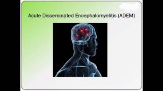 ADEM Acute disseminated encephalomyelitis History Management mrcpch Clinical [upl. by Armin]