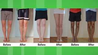 Bow Legs Correction Exercises  How to fix Bow Legs  Bow Legs Correction without surgery [upl. by Lleihsad293]