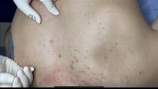 ACNE TREATMENT WITH VU QUYNH MI  Acne Squeeze on Back [upl. by Atsylac]