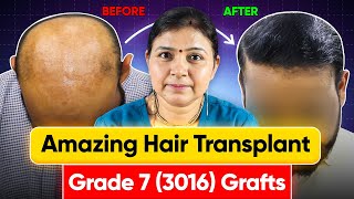 Best Hair Transplant in Agra 3016 Grafts Norwood Grade 7 Hair Loss at Saraswat Hospital India [upl. by Worrell86]